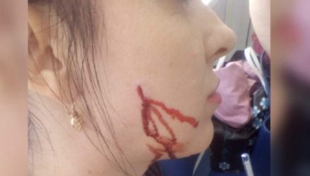 Проткнула щёку. Cотрудница банка вонзила ручку в лицо клиентки