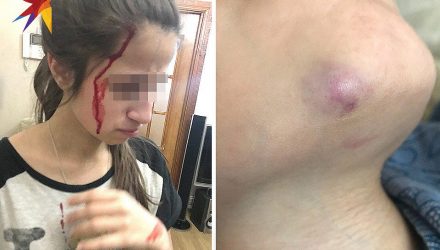 Мать сестёр Хачатурян показала фотографии избитых отцом девушек