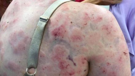 Мать закрыла грудную дочь собой от огромного града и спасла ей жизнь