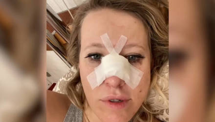Собчак срочно провели операцию после того, как она упала, сломав нос — видео