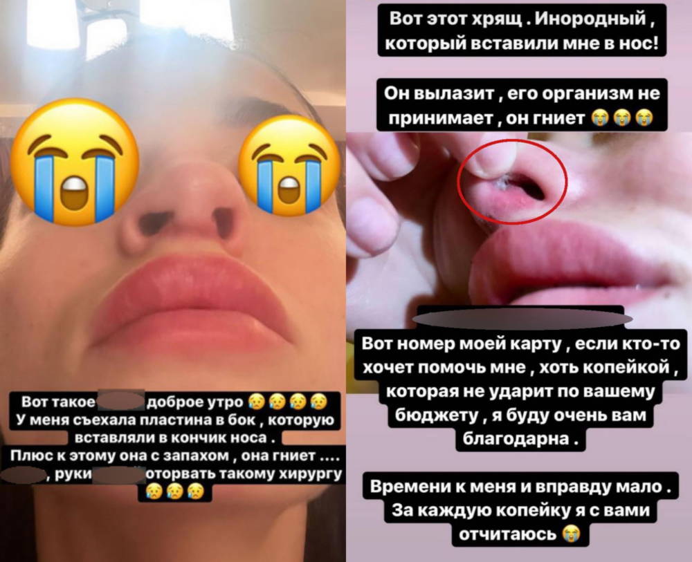 Анастасия Балинская нос